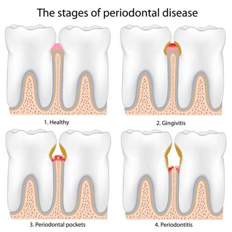 osseous surgery for periodontal disease